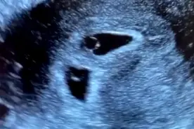 孕5周+，一超看见双孕囊，是双胞胎哦，待出胎心！😘#试管婴儿视频封面