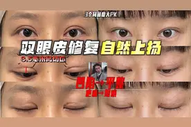 3个同角度大PK！全切双眼皮后切口高达8.5mm宽深假眼修复自然上扬视频封面
