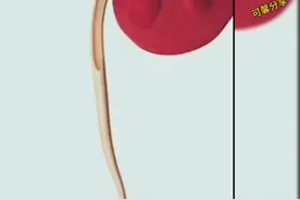 肾结石的取出过程！视频封面
