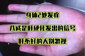 身体2处发痒，八成是肝硬化发出的信号，肝不好的人别忽视视频封面