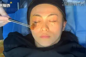 真实记录：34岁姑娘挑战不开刀去眼袋，分享手术全过程！视频封面