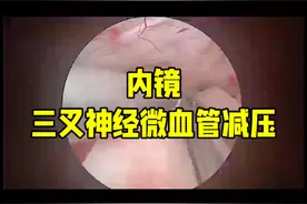 上海交大仁济浦南分院神外赵江主任演示内镜三叉神经微血管减压视频封面