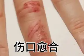 伤口是怎么样愈合的！让我们来看看这个愈合过程！视频封面