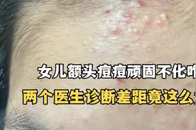 女儿额头长痘痘 顽固不化怎么办？这两个医生诊断差距竟然这么大视频封面