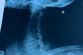 患者角度看颈椎第16集#北医三院#脊柱分组视频封面