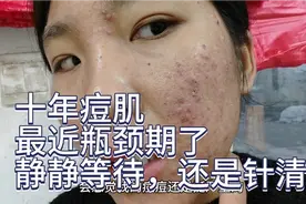 十年痘肌，吃eva三个月，你们感觉效果怎么样视频封面