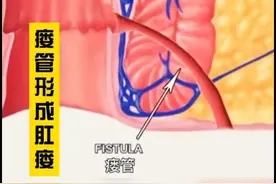 肛瘘形成的动画演示视频封面
