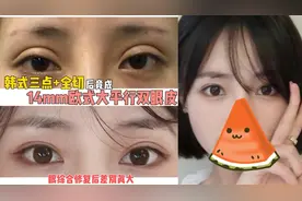 韩式三点+全切后竟成14mm欧式大平行双眼皮，眼综合修复后差别大视频封面