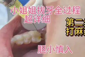 超详细的拔牙根过程，不熟悉拔牙过程的可以来。