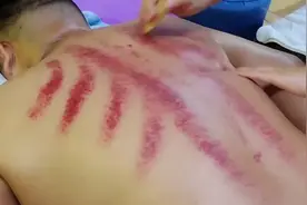 刮痧刮出来的痧是什么？真的是体内毒素吗？出痧越多越好吗？视频封面