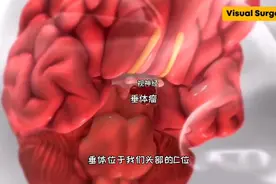 巨人症的原因，垂体瘤手术过程，3D演示。。