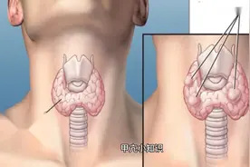甲亢小知识视频封面