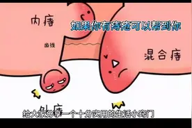 简单方法可让痔疮自愈视频封面
