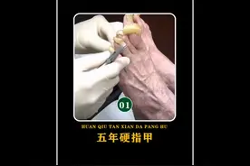美国老表五年不剪脚指甲，导致指甲盖又硬又厚，都是风俗的事情啊视频封面