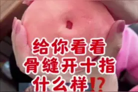 分娩时开十指究竟有多大，妈妈们辛苦了视频封面