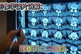 病案分享：影像学读片分析讲解，腰椎间盘突出症！视频封面