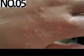 一到夏天，手上就长透明小水泡，可以这样处理，艾特你身边有汗疱疹的朋友看看吧#汗疱疹 #湿疹 #皮肤 视频封面