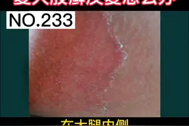 大腿内侧红斑起皮瘙痒，还会扩大， #股癣 怎么办？ #体癣  #皮肤  #科普视频封面