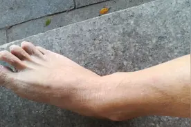 鱼鳞病皮肤脚这个位置出汗好难搞哟，出汗了小腿位置皮肤就恢复了视频封面