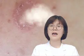 你们经常问的玫瑰糠疹，处理方法来啦#科普 #皮肤 #玫瑰糠疹 #红斑视频封面