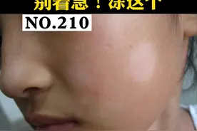 孩子脸上长了白斑，家长不用太担心，可能是这个原因#皮肤 #白色糠疹 #健康科普 视频封面