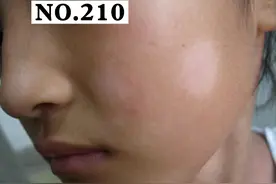 孩子脸上长了白斑，家长不用太担心，可能是这个原因#皮肤 #白色糠疹 #健康科普 视频封面