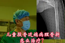 儿童股骨近端病理骨折怎么治疗？#健康守护计划 #股骨骨折 #骨折 #病理 #弹性髓内针视频封面