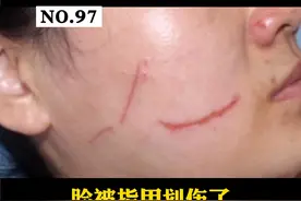 脸不小心被指甲划伤了，没处理好，容易留疤，非常影响颜值，所以，第一时间正确处理很关键#疤痕 #医学科普 视频封面