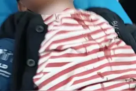 攀枝花一幼儿园6岁儿童被筷子插入鼻子致穿孔（极目新闻）视频封面