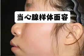 当心腺样体面容，影响孩子颜值 #硬核健康科普行动 #腺样体面容 #腺样体面容的危害 #腺样体肥大 #腺样体面容如何改善视频封面