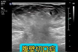 腹壁切口疝超声表现。#医学科普 #超声影像 #超声学习 #每天学习一点点 #抖音同城 @抖音短视频视频封面