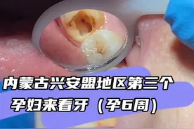 刚怀孕6周，两边牙齿都疼不能吃饭，母亲营养不足会影响胎儿发育视频封面