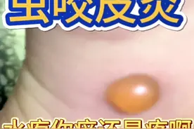 门诊故事-虫咬皮炎#虫咬皮炎 #丘疹性荨麻疹视频封面