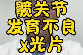 髋关节发育不良的x光片表现#医学科普 #儿童骨科 #髋关节发育不良 #视频仅供参考如有不适请线下就医 #育儿视频封面