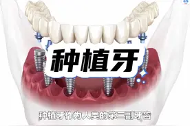 种植牙要谨慎，不是谁都可以随便种的视频封面