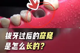 拔牙后的窟窿是怎么长好的？ #舒林径  #爱护牙齿 #解压 #一口好牙 #硬核健康科普行动视频封面