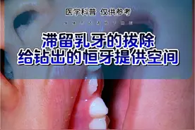 恒牙萌出，乳牙滞留怎么办 #乳牙拔除 #乳牙滞留怎么办 #乳牙滞留 #儿童牙齿科普小知识 @DOU+小助手 @抖音医疗健康小助手 @健康中国 @健康北京视频封面