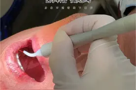 激光治疗牙周炎 #牙周炎 #牙周袋 #激光口腔诊疗 #如何预防牙周炎 #口腔医生赵晶 @DOU+小助手 @抖音医疗健康小助手 @健康中国 @健康北京视频封面