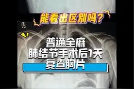 Tubeless无管肺结节手术，术后腹胀、恶心等全麻不良反应大大减少#肺结节 #单孔胸腔镜 #磨玻璃结节 #无管手术视频封面