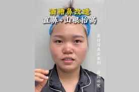 酒糟鼻大改造！直鼻加山根抬高！ #鼻整形#鼻修复#吴付习#吴付习软糖鼻#变美视频封面