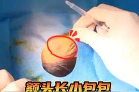 苏州小姐姐额头上长包块 该怎么处理 #皮脂腺囊肿切除 #脂肪瘤切除 #肿物切除 #病理 #苏大附一院邵凯视频封面