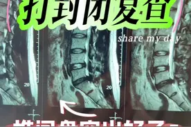 #封闭#骶管注射 #腰椎间盘突出 封闭在一定条件下是可以缓解症状的，但不能无限放大他的作用@骨筋中外的康复小站视频封面