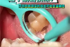 这个牙颈部有很深的龋齿可能会漏神经 #牙颈部龋 #牙颈部缺损 #龋坏的牙齿该怎么办 #补牙 #口腔医生赵晶 @DOU+小助手 @抖音医疗健康小助手 @健康中国视频封面