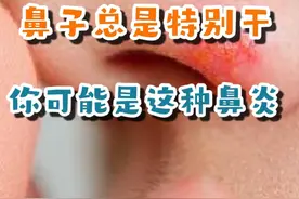 鼻炎发作时，鼻子总是特别干，可能是这种鼻炎#火热鼻炎视频封面