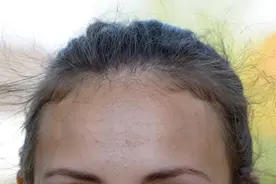 耳垂下面长了小疙瘩，别不当回事！可能是恶性肿瘤的前兆？图片