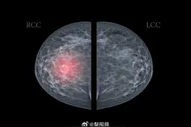 乳腺结节能自己消失吗？乳腺结节可能癌变吗？图片