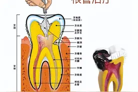 以前“根管治疗”都不用抽神经，为什么现在要拔掉牙神经？图片