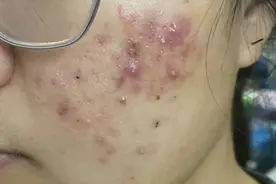 热门祛痘膏分享！过来人实测国货更靠谱，痘痘痘印全消了！图片