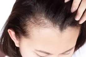 发际线为何有高有低？皮肤科专家教你守住“头顶阵地”图片
