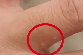 这种病一到晚上就痒，还可能传染全家图片
